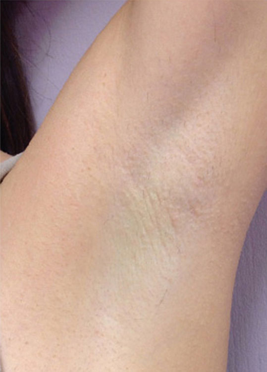 Under Arm Laser Hair Removal for Women